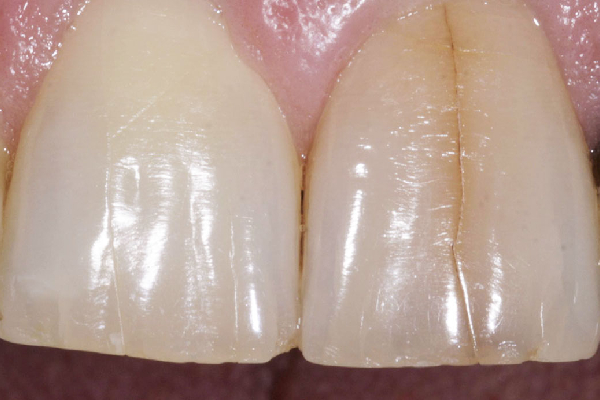 Dental Crown for Cracked Tooth