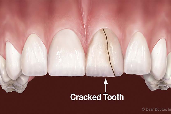 Bonding Treatment for Cracked Tooth