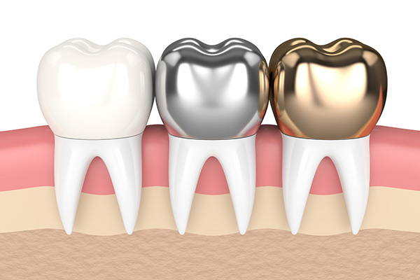 Dental Crown Step 3