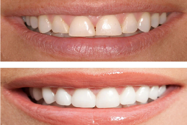 Resin Application and Shaping