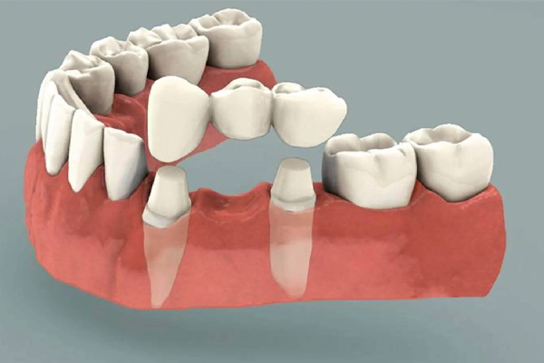 Final Dental Bridge Result