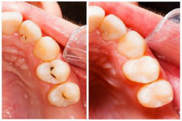 Dental Crown Placement