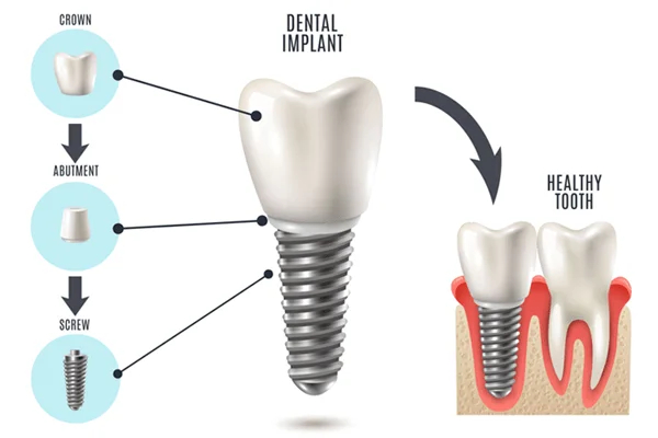 Dental Implant Step 2