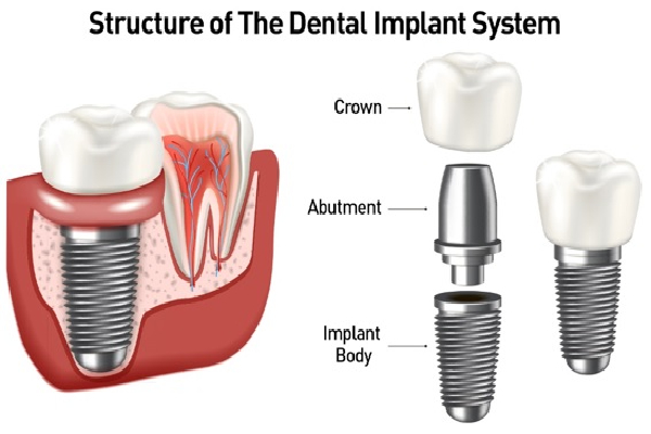 Dental Implant Step 3