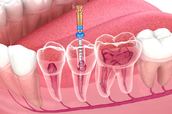 Root Canal Cleaning and Sealing