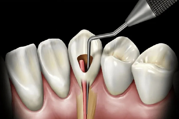 Restoration after Root Canal