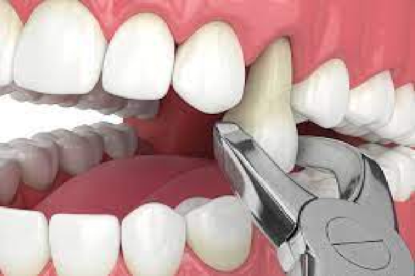 Tooth Removal Procedure