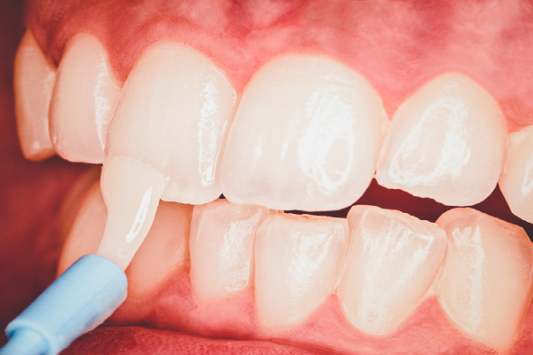 Healthy Teeth After Fluoride