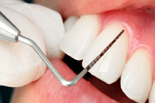 Scaling and Root Planing