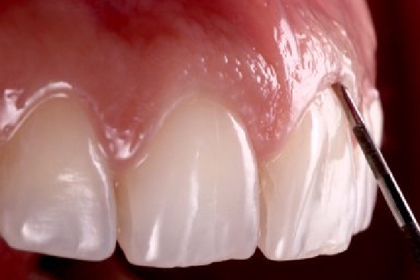 Gum Surgery and Treatment