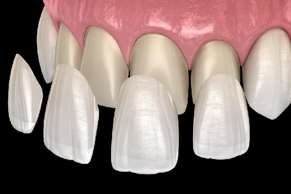 Custom Veneer Design