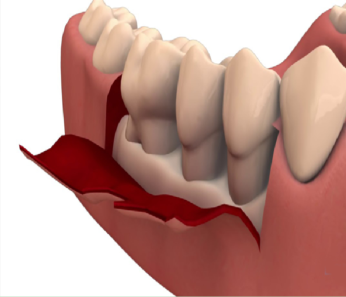 Flap Surgery