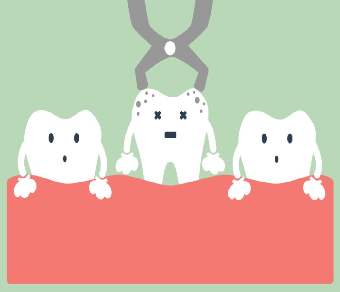 Tooth Extraction