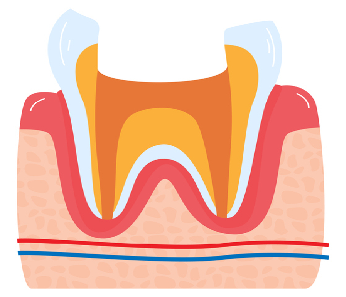 Pulpotomy