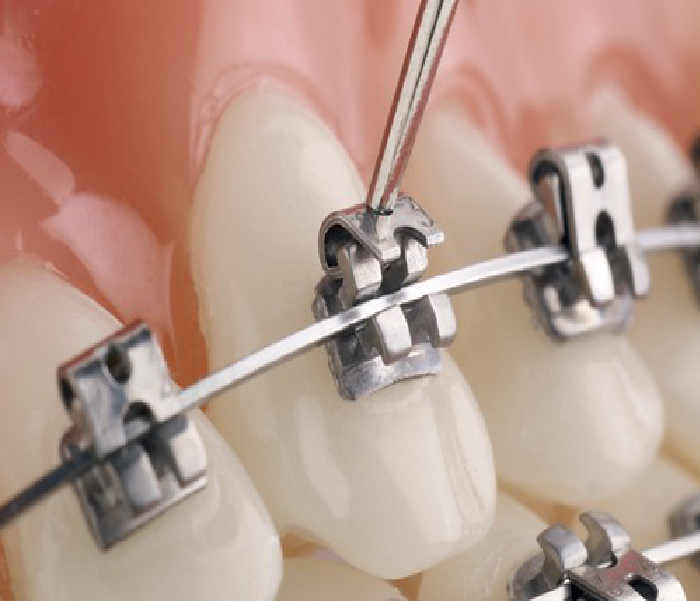 Self-Ligating Braces